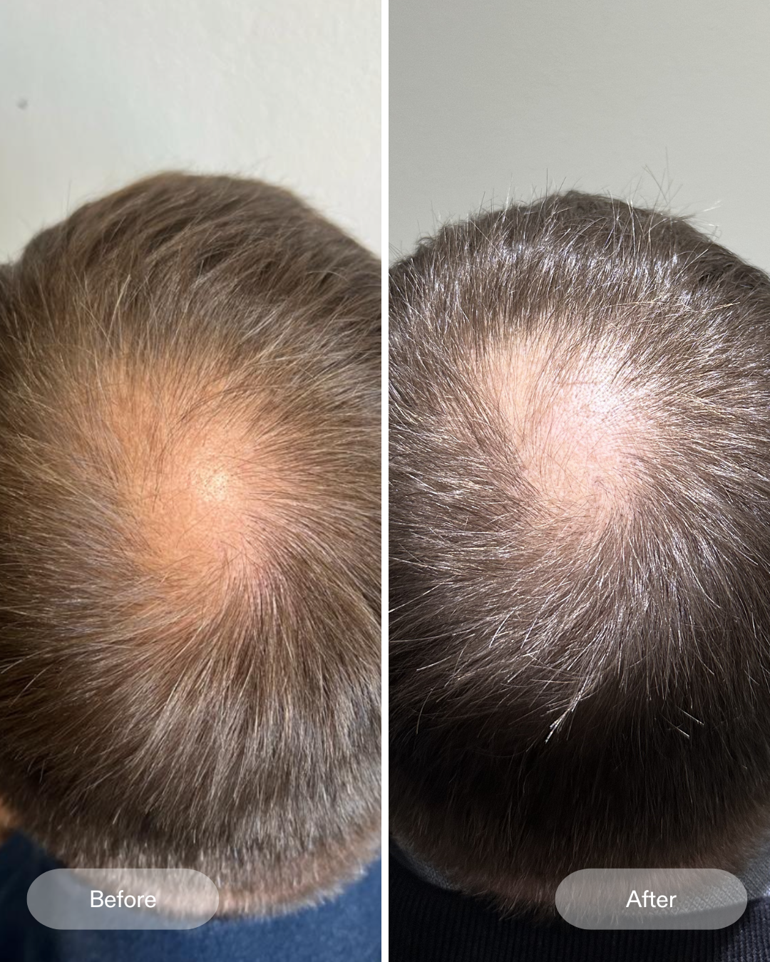 Vorher Nachher Ergebnisse der klinischen Studie zum CurrentBody Skin LED-Haarwuchshelm gegen Haarausfall