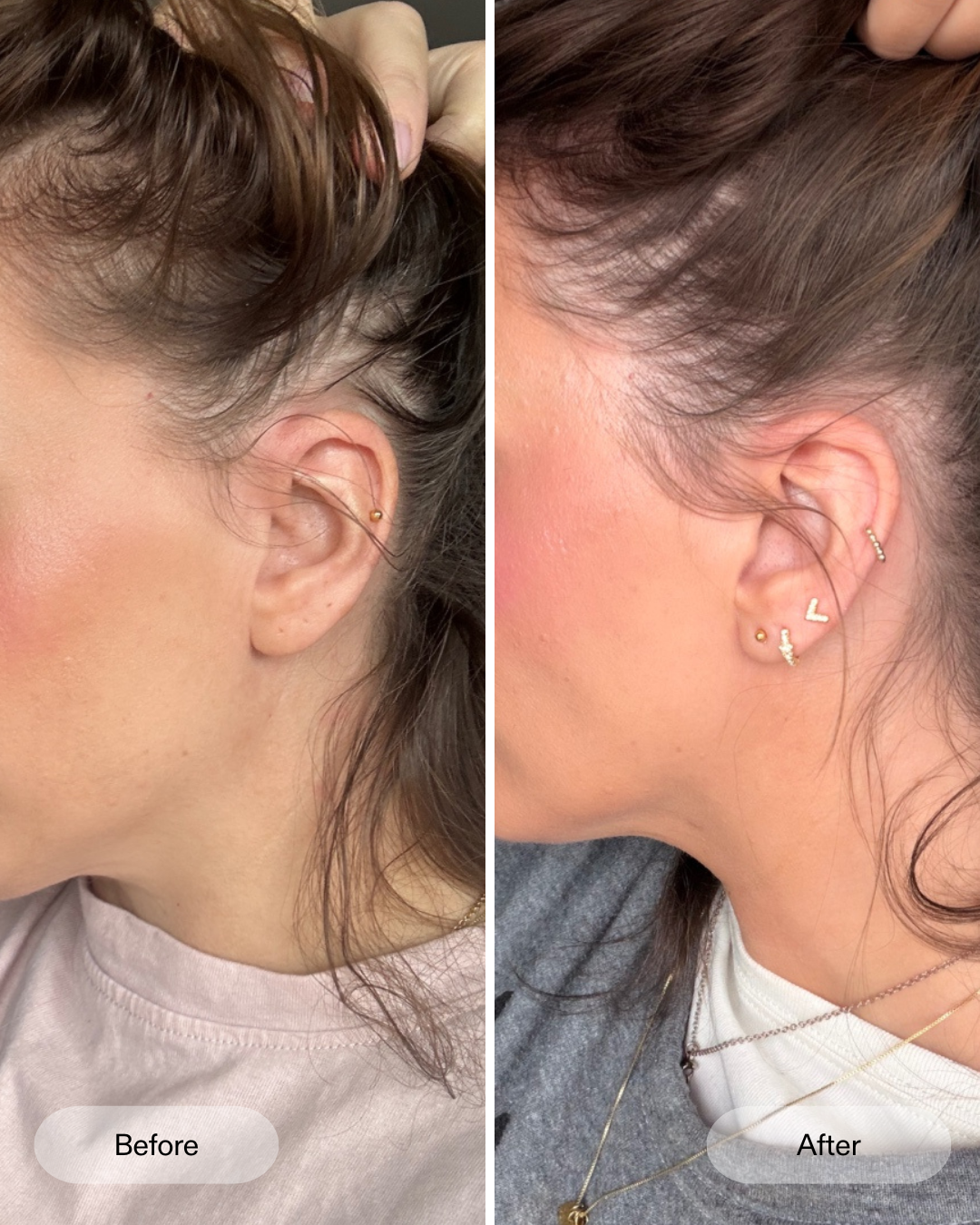 Vorher Nachher Ergebnisse der klinischen Studie zum CurrentBody Skin LED-Haarwuchshelm gegen Haarausfall