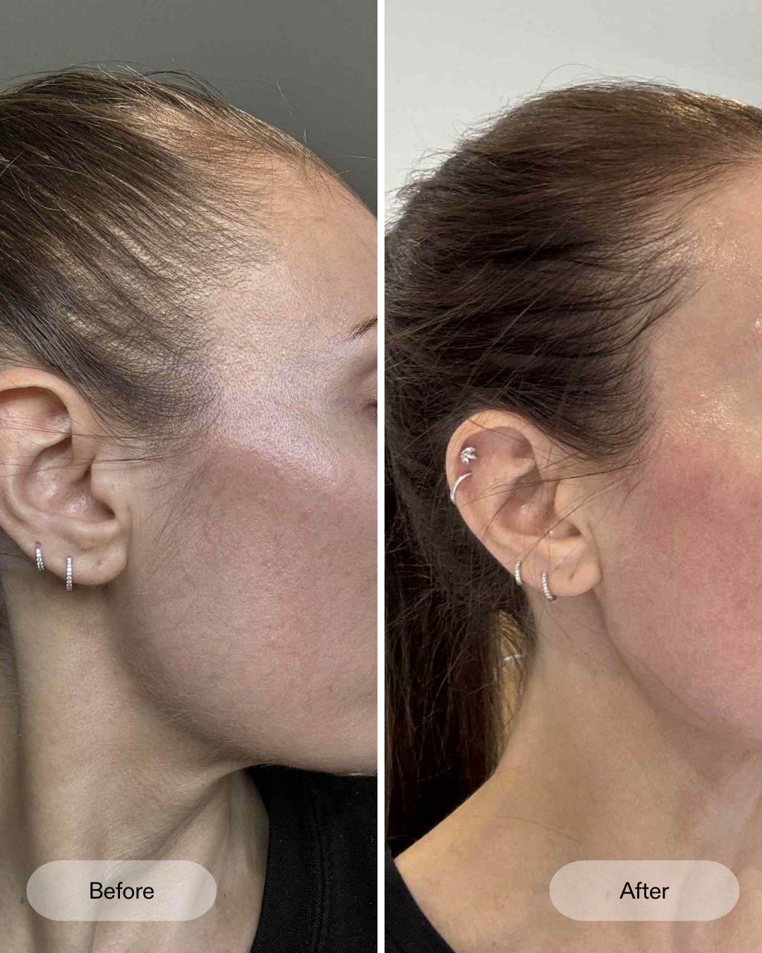 Vorher Nachher Ergebnisse der klinischen Studie zum CurrentBody Skin LED-Haarwuchshelm gegen Haarausfall