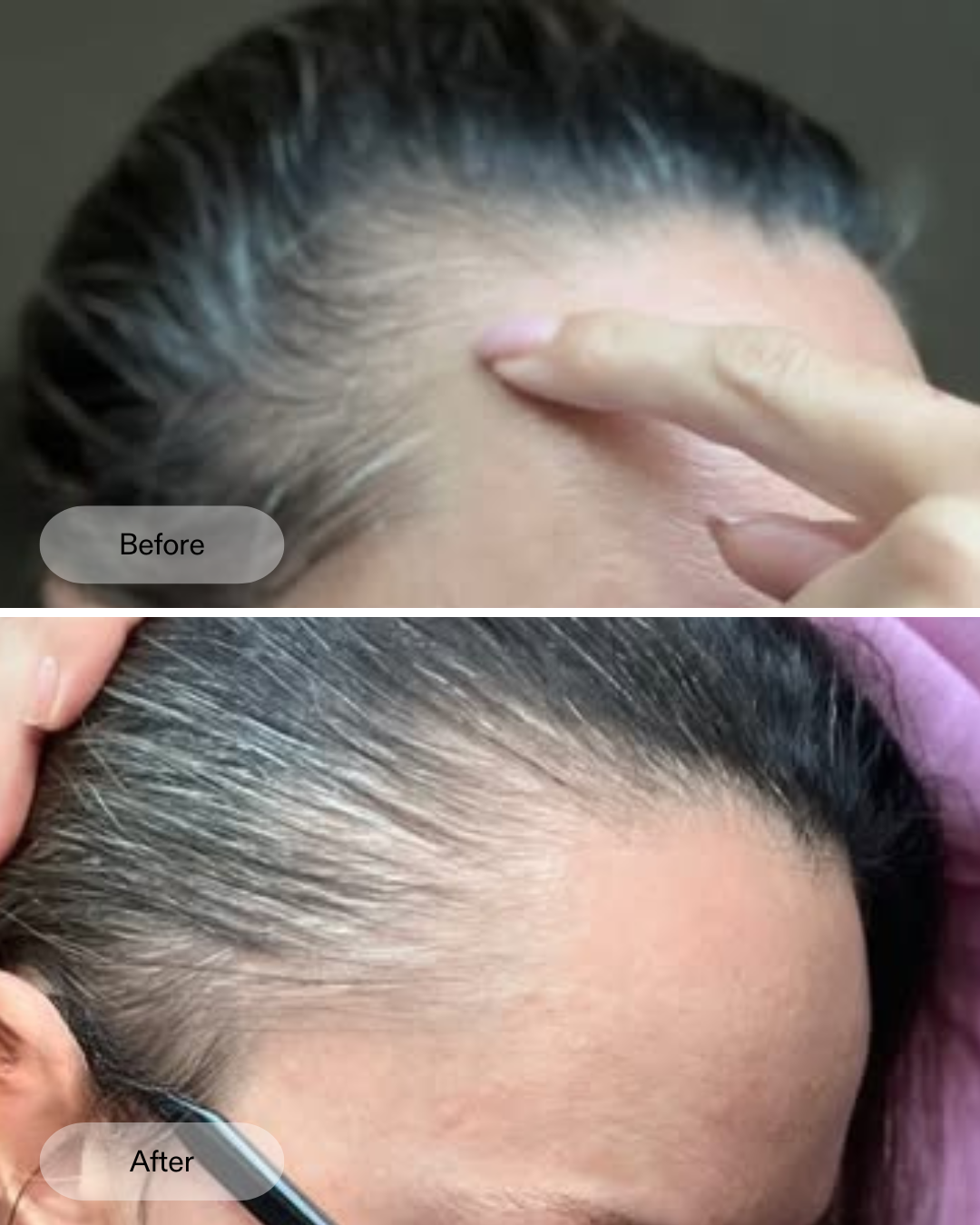 Vorher Nachher Ergebnisse der klinischen Studie zum CurrentBody Skin LED-Haarwuchshelm gegen Haarausfall