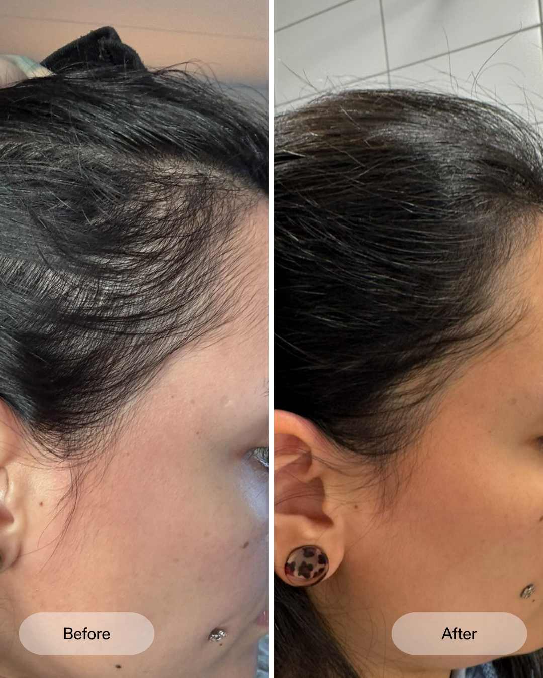 Vorher Nachher Ergebnisse der klinischen Studie zum CurrentBody Skin LED-Haarwuchshelm gegen Haarausfall